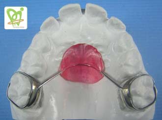 فضانگهدار سیم کمانی پشت دندانی - انواع فضا نگهدار دندان کودکان - دکتر فائزه فتوحی