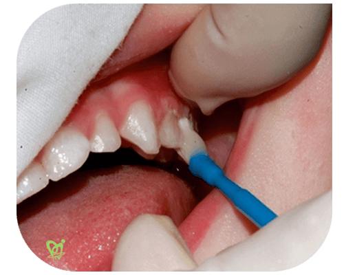 فلوراید تراپی دندان کودکان - دکتر فائزه فتوحی