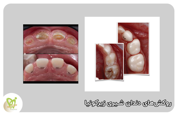 روکش دندان شیری زیرکونیا - دکتر فائزه فتوحی