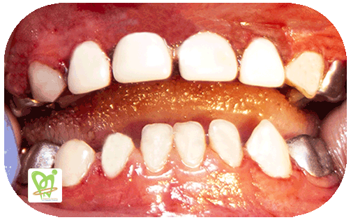 روکش زیرکونیا یا روکش همرنگ دندان کودکان - دکتر فائزه فتوحی