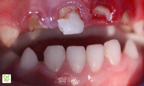نمونه کار روکش زیرکونیا دندان شیری ( قبل از انجام ) امین 2 ساله