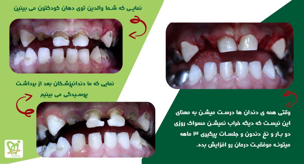 نمونه کار آرامبخشی دندانپزشکی کودکان - دکتر فائزه فتوحی