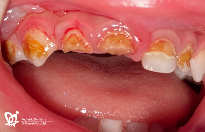 عکس پوسیدگی دندان کودکان - دکتر فائزه فتوحی