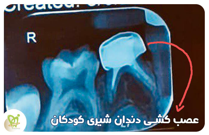 عصب کشی دندان شیری کودکان چگونه است و انواع آن - دکتر فائزه فتوحی