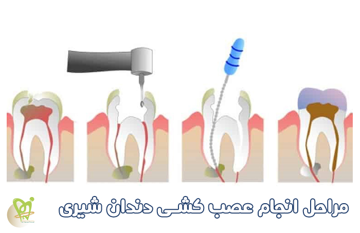 مراحل انجام عصب کشی دندان شیری کودکان - دکتر فائزه فتوحی