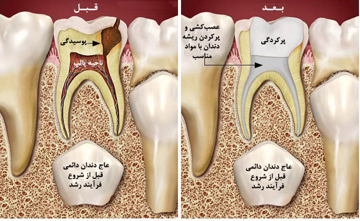 عصب کشی دندان شیری چگونه انجام می‌شود؟ - دکتر فائزه فتوحی 