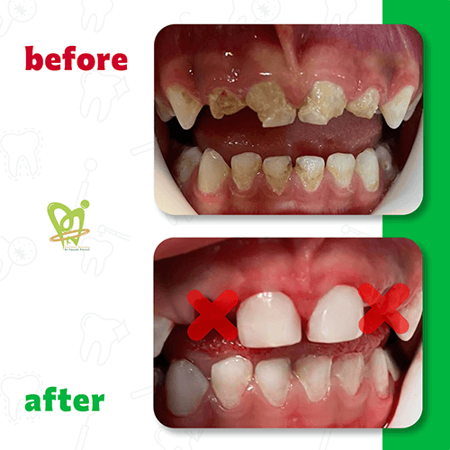 قبل و بعد از دندانپزشکی کودکان دکتر فائزه فتوحی 1