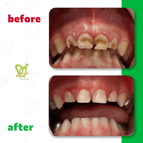 قبل و بعد از دندانپزشکی کودکان دکتر فائزه فتوحی 2