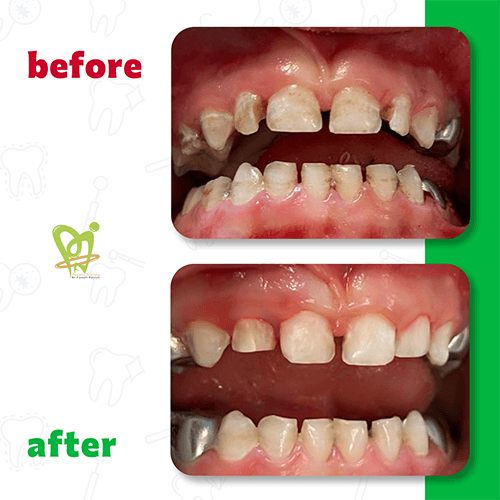 قبل و بعد از دندانپزشکی کودکان دکتر فائزه فتوحی 3