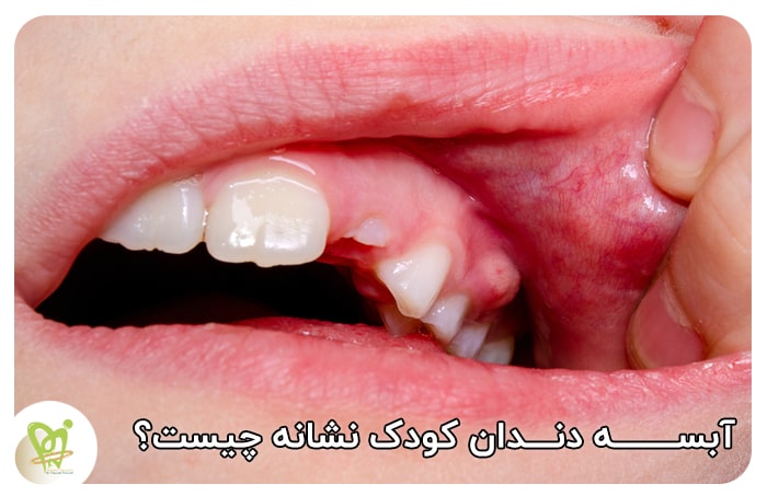 آبسه دندان کودک نشانه چیست - دکتر فائزه فتوحی
