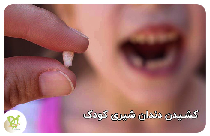 کشیدن دندان شیری کودک - دکتر فائزه فتوحی