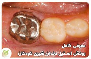 روکش استیل دندان شیری کودکان - دکتر فائزه فتوحی