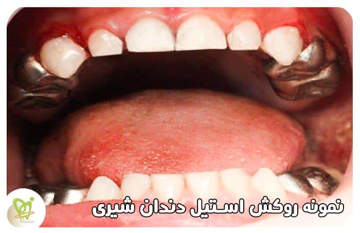 نمونه روکش استیل دندان شیری کودکان - دکتر فائزه فتوحی