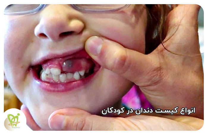 کیست دندان در کودکان - دکتر فائزه فتوحی