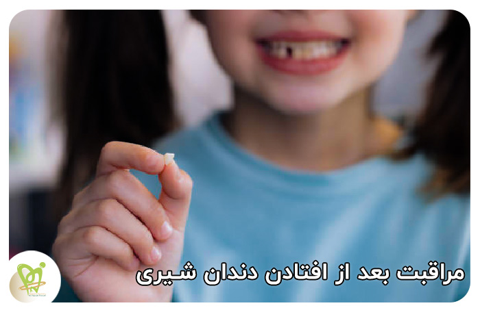 مراقبت بعد از افتادن دندان شیری - دکتر فتوحی