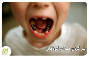 پر کردن دندان کودکان - دکتر فائزه فتوحی