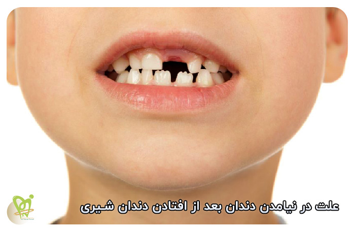 علت در نیامدن دندان بعد از افتادن دندان شیری - دکتر فائزه فتوحی